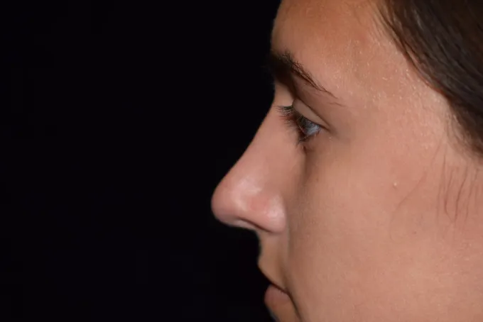 before-after-rhinoplasty-22d