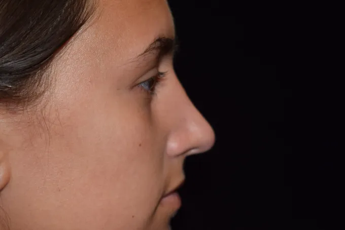 before-after-rhinoplasty-22f