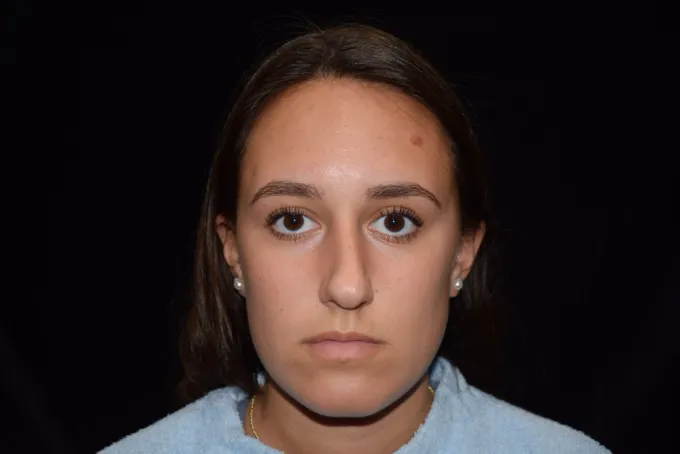 before-after-rhinoplasty-22g