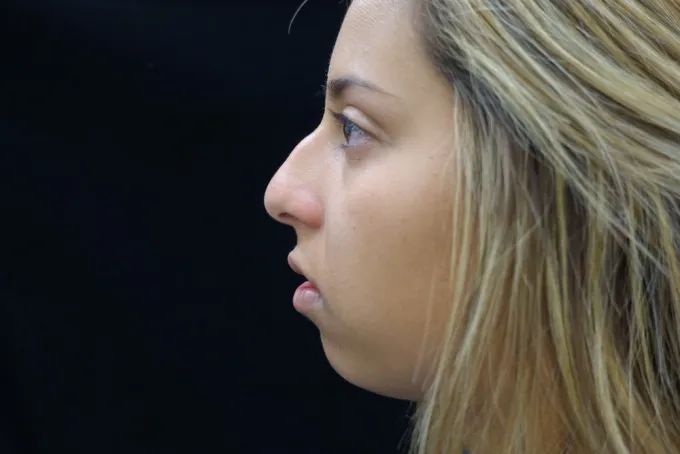 before-after-rhinoplasty-33c