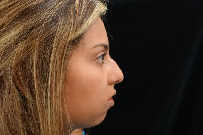 before-after-rhinoplasty-33e