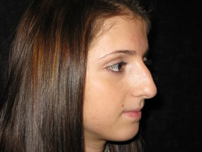 before-after-rhinoplasty-44c