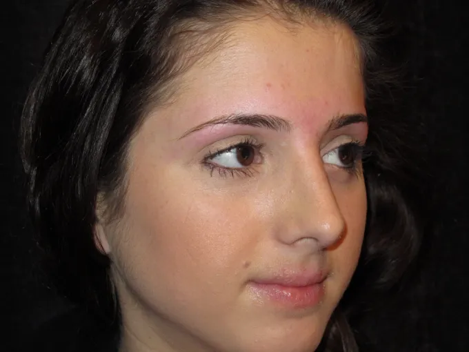 before-after-rhinoplasty-44d
