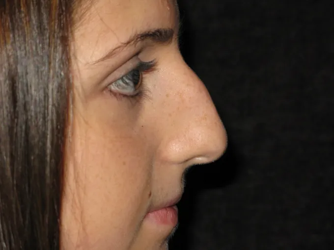 before-after-rhinoplasty-44e