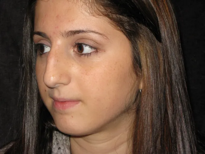 before-after-rhinoplasty-44g