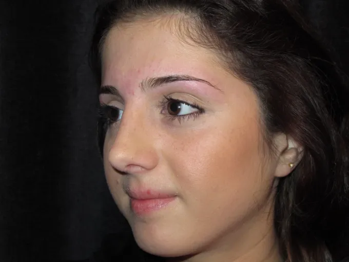 before-after-rhinoplasty-44h