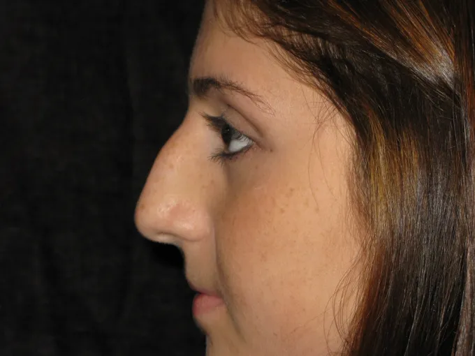 before-after-rhinoplasty-44i