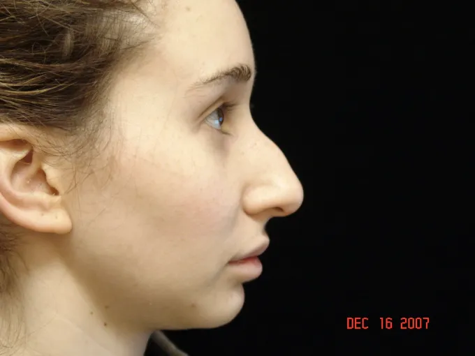 before-after-rhinoplasty-55c
