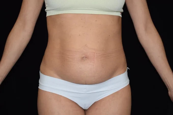 before-after-tummy-tuck-abdominoplasty-1010a