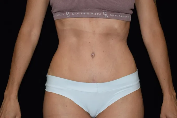 before-after-tummy-tuck-abdominoplasty-1010b