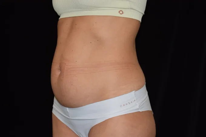 before-after-tummy-tuck-abdominoplasty-1010c