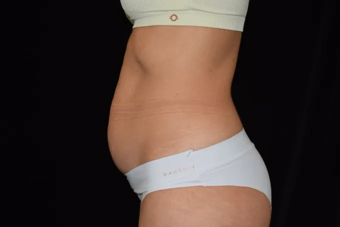 before-after-tummy-tuck-abdominoplasty-1010e