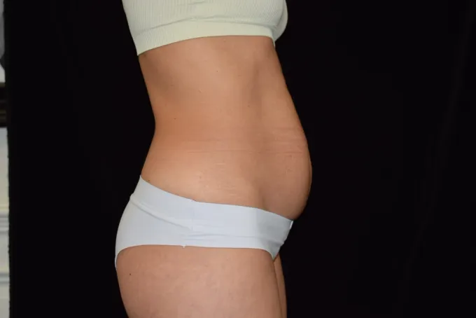 before-after-tummy-tuck-abdominoplasty-1010i