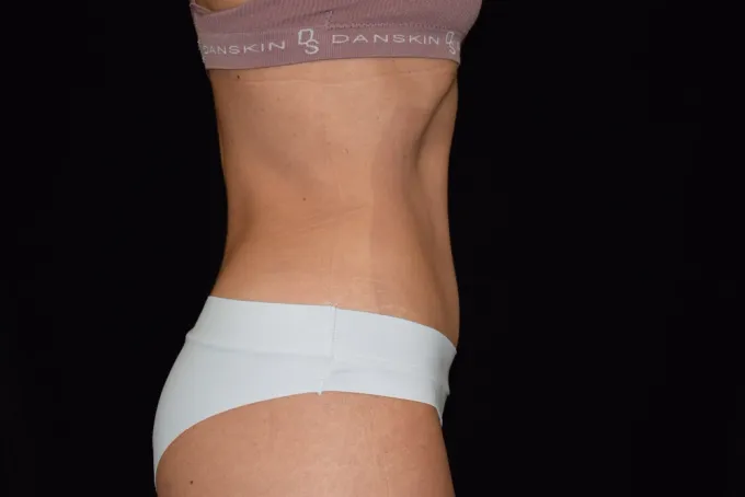 before-after-tummy-tuck-abdominoplasty-1010j