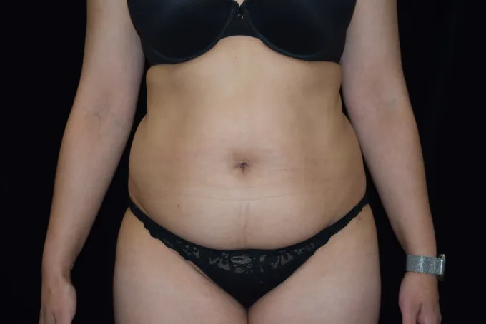 before-after-tummy-tuck-abdominoplasty-1111a