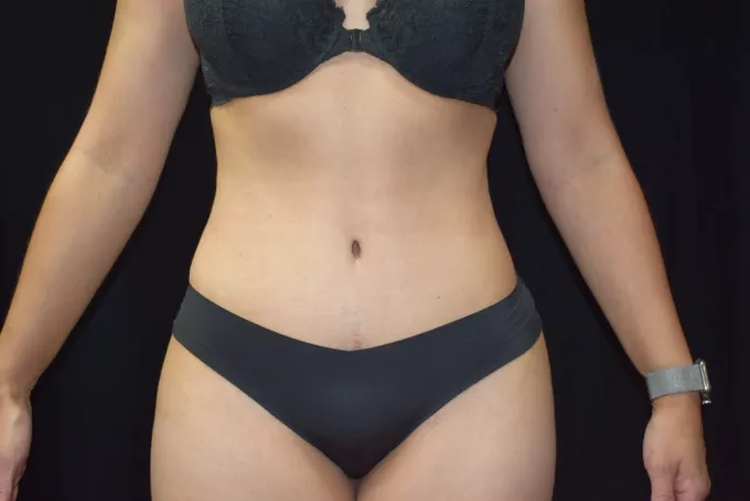 before-after-tummy-tuck-abdominoplasty-1111b