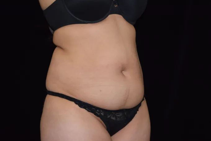 before-after-tummy-tuck-abdominoplasty-1111a