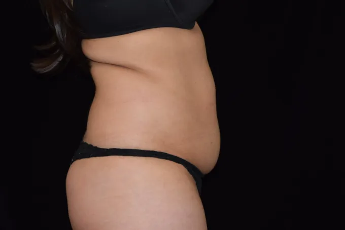 before-after-tummy-tuck-abdominoplasty-1111a