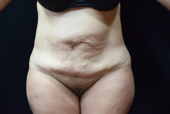 before-after-tummy-tuck-abdominoplasty-1212a