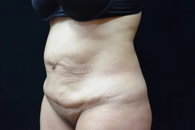 before-after-tummy-tuck-abdominoplasty-1212a
