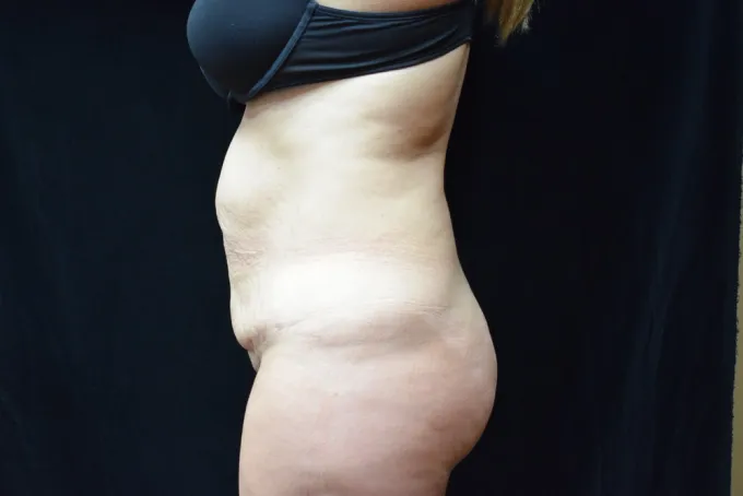 before-after-tummy-tuck-abdominoplasty-1212a