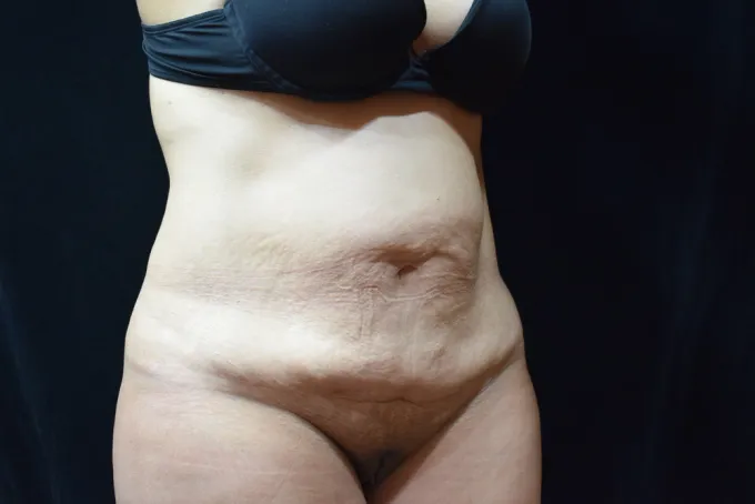 before-after-tummy-tuck-abdominoplasty-1212a