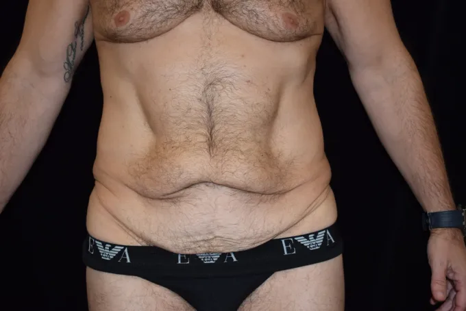 before-after-tummy-tuck-abdominoplasty-1212a