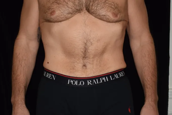 before-after-tummy-tuck-abdominoplasty-1313b