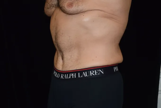 before-after-tummy-tuck-abdominoplasty-1313d