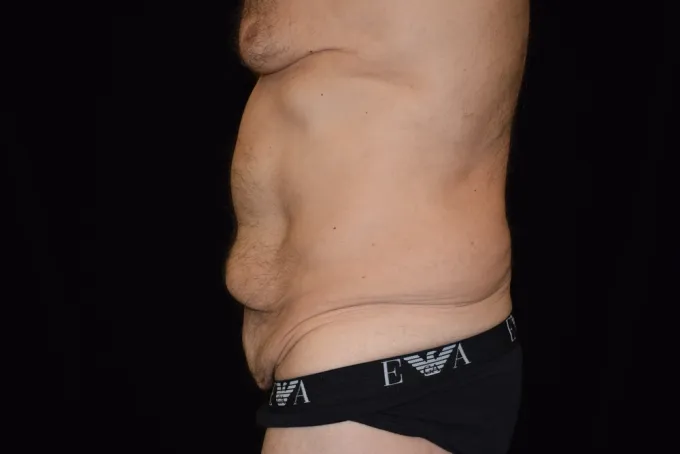 before-after-tummy-tuck-abdominoplasty-1212a