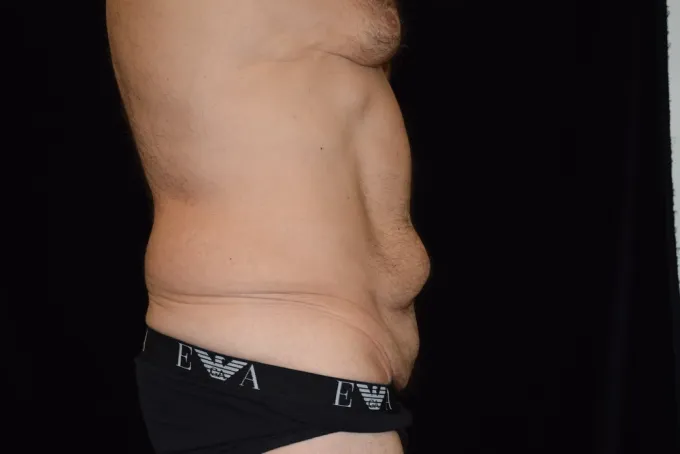 before-after-tummy-tuck-abdominoplasty-1212a