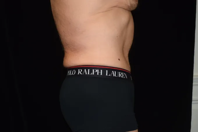 before-after-tummy-tuck-abdominoplasty-1313j