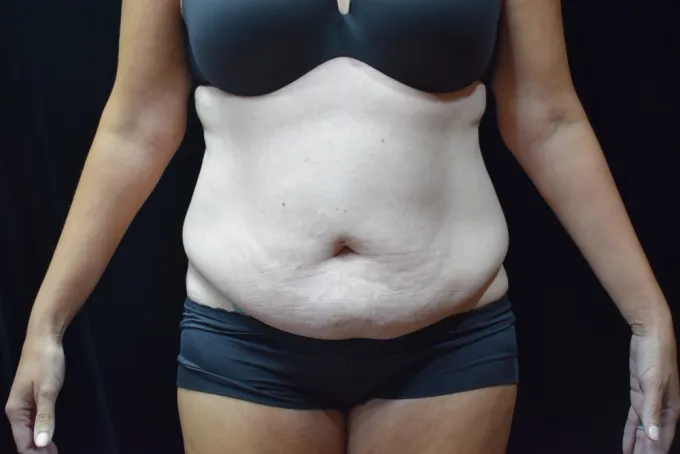 before-after-tummy-tuck-abdominoplasty-1212a