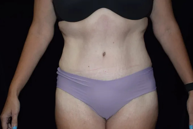 before-after-tummy-tuck-abdominoplasty-1414b