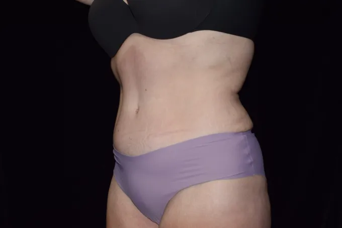 before-after-tummy-tuck-abdominoplasty-1212a
