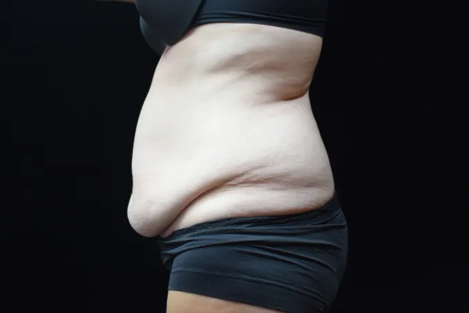 before-after-tummy-tuck-abdominoplasty-1414f