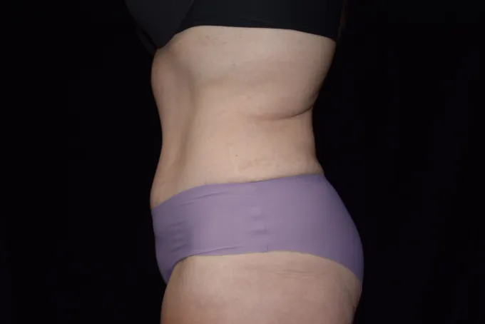 before-after-tummy-tuck-abdominoplasty-1212a