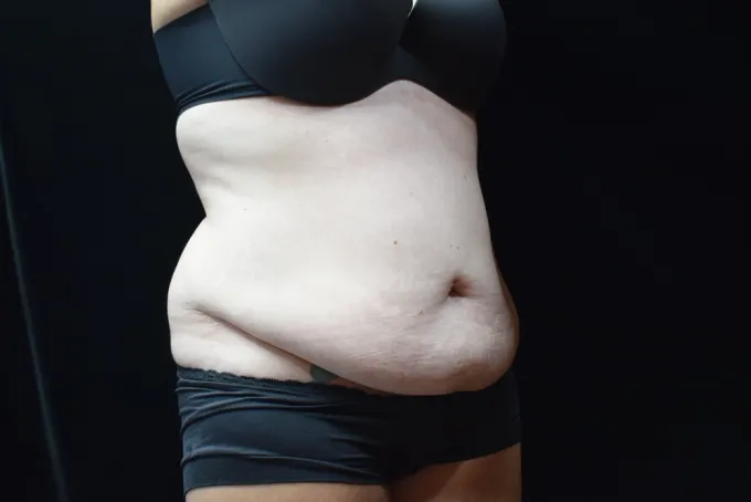 before-after-tummy-tuck-abdominoplasty-1414h