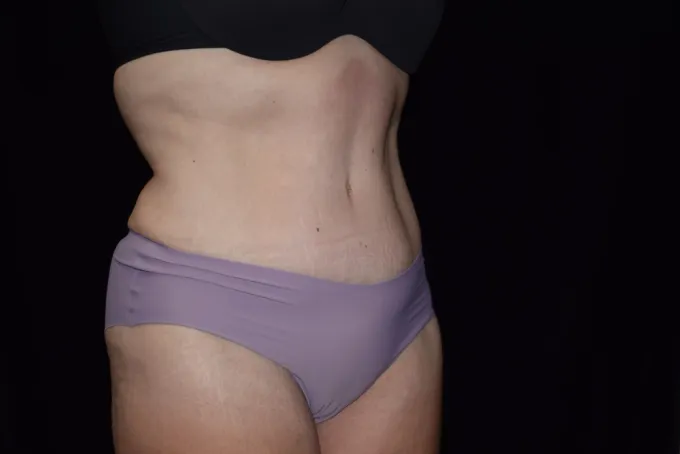 before-after-tummy-tuck-abdominoplasty-1212a