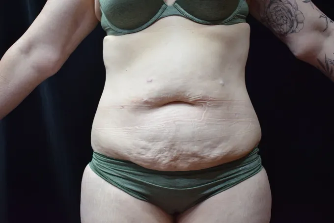 before-after-tummy-tuck-abdominoplasty-1212a