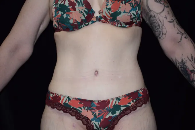 before-after-tummy-tuck-abdominoplasty-1616b