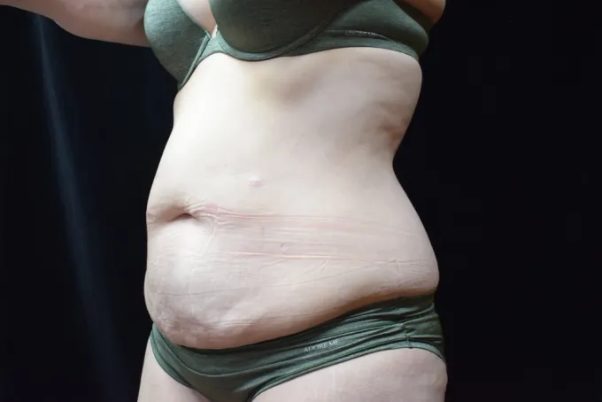 before-after-tummy-tuck-abdominoplasty-1212a