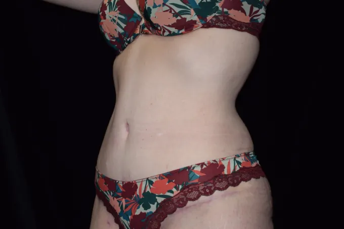 before-after-tummy-tuck-abdominoplasty-1616d