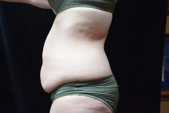 before-after-tummy-tuck-abdominoplasty-1212a