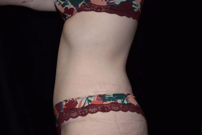 before-after-tummy-tuck-abdominoplasty-1616f