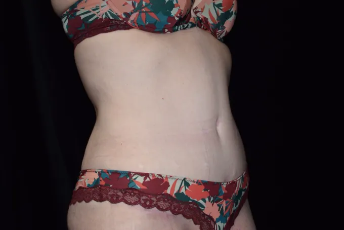 before-after-tummy-tuck-abdominoplasty-1616h