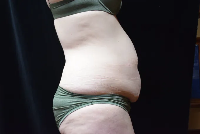 before-after-tummy-tuck-abdominoplasty-1212a