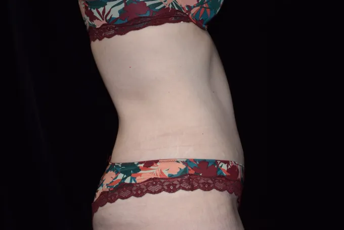 before-after-tummy-tuck-abdominoplasty-1616j