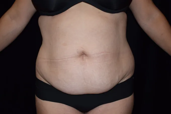 before-after-tummy-tuck-abdominoplasty-1212a