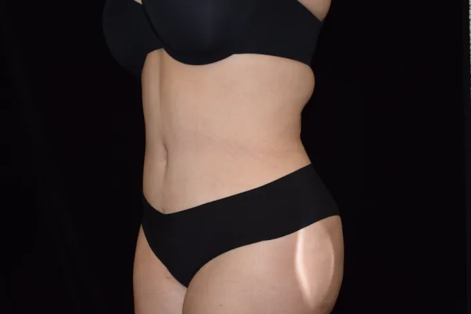before-after-tummy-tuck-abdominoplasty-1212a